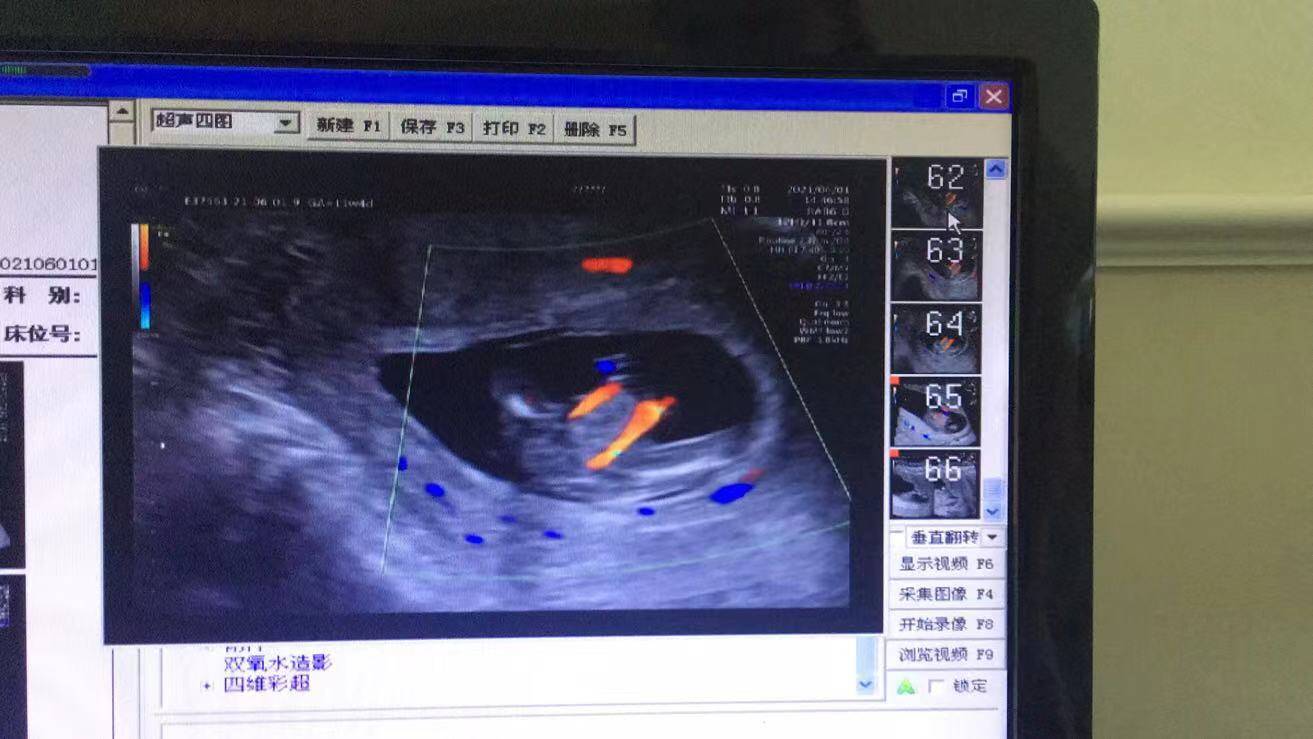 NT筛查出胎儿多发畸形,准妈妈无奈终止妊娠